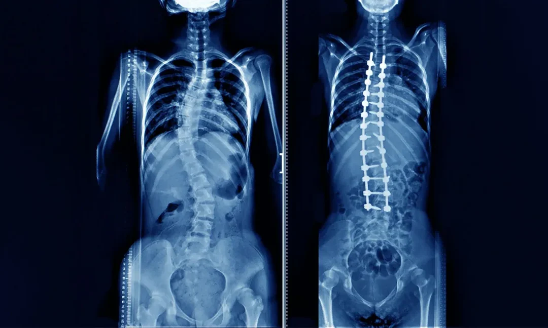 Scoliosis: 3 Simple Home Screening Tests to Assess Your Symptoms