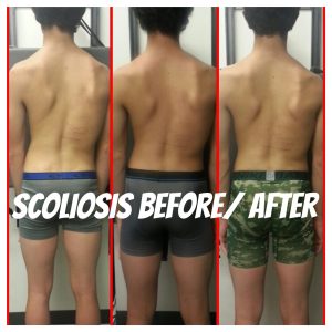 Matsuno Wellnes Helps Scoliosis